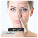 علاج حب الشباب – طرق علاج حب الشباب نهائيا